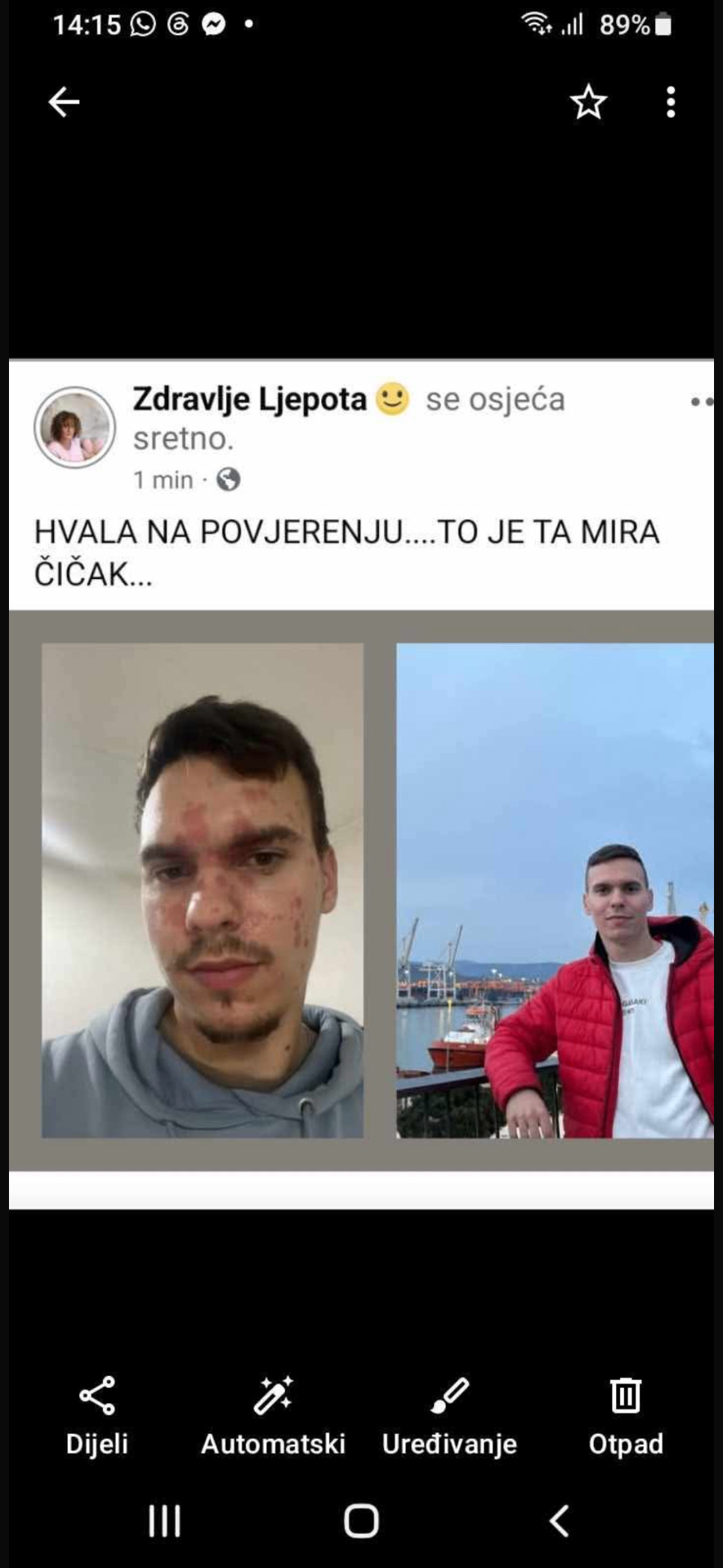 Koža lica — prije i poslije prirodnog melema